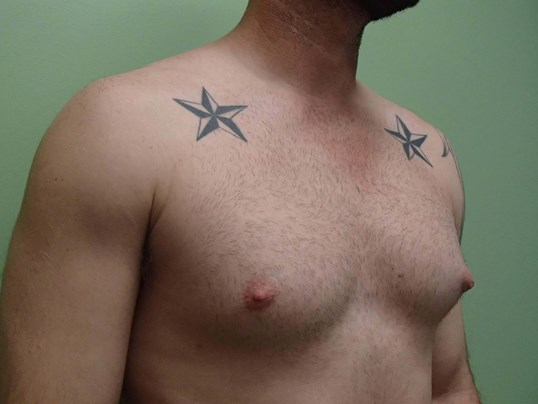 Gynecomastia (male breast redu Before