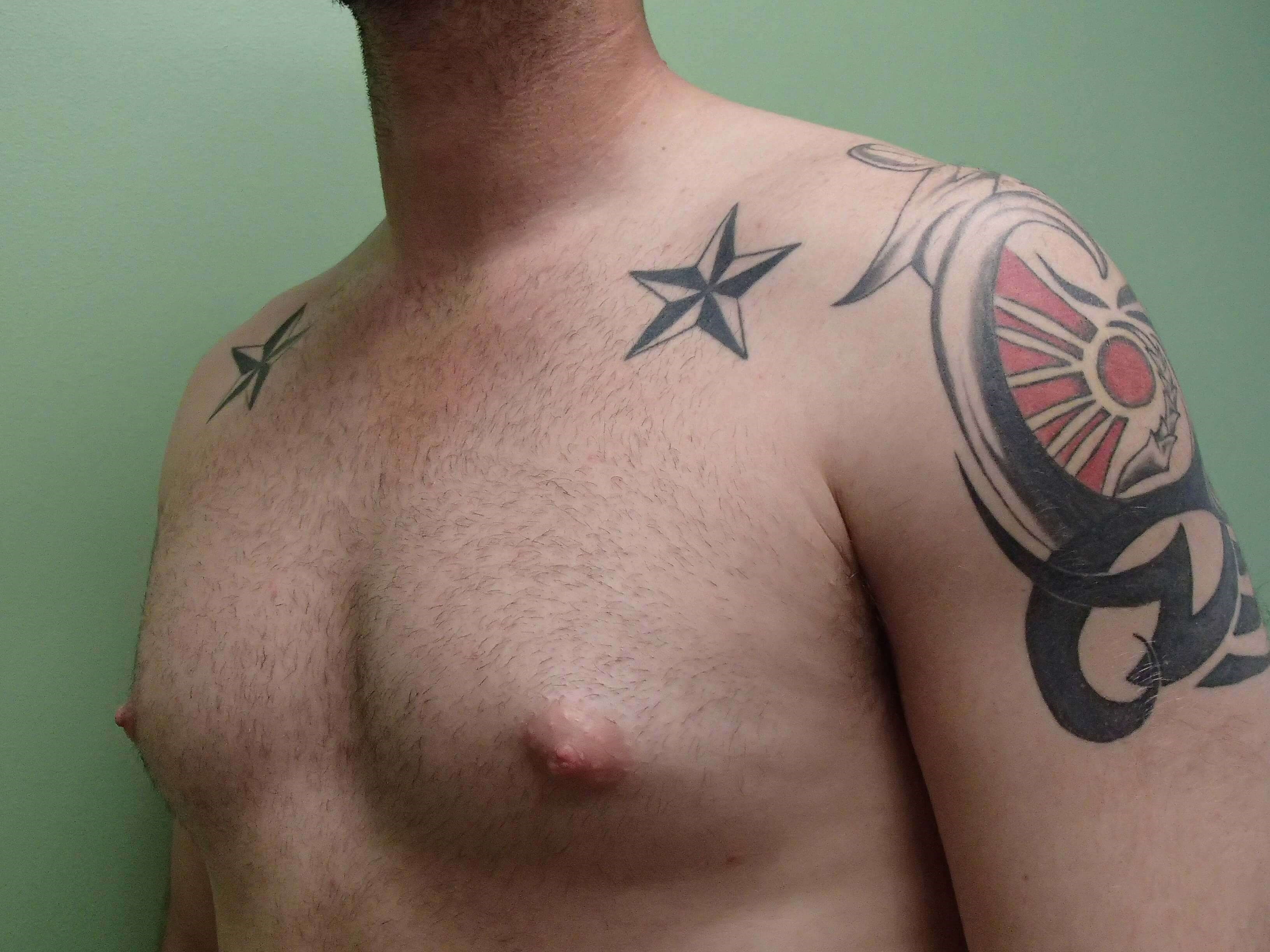 Gynecomastia (male breast redu Before
