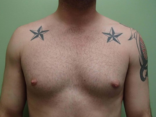 Gynecomastia (male breast redu Before