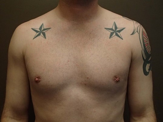 Gynecomastia (male breast redu After