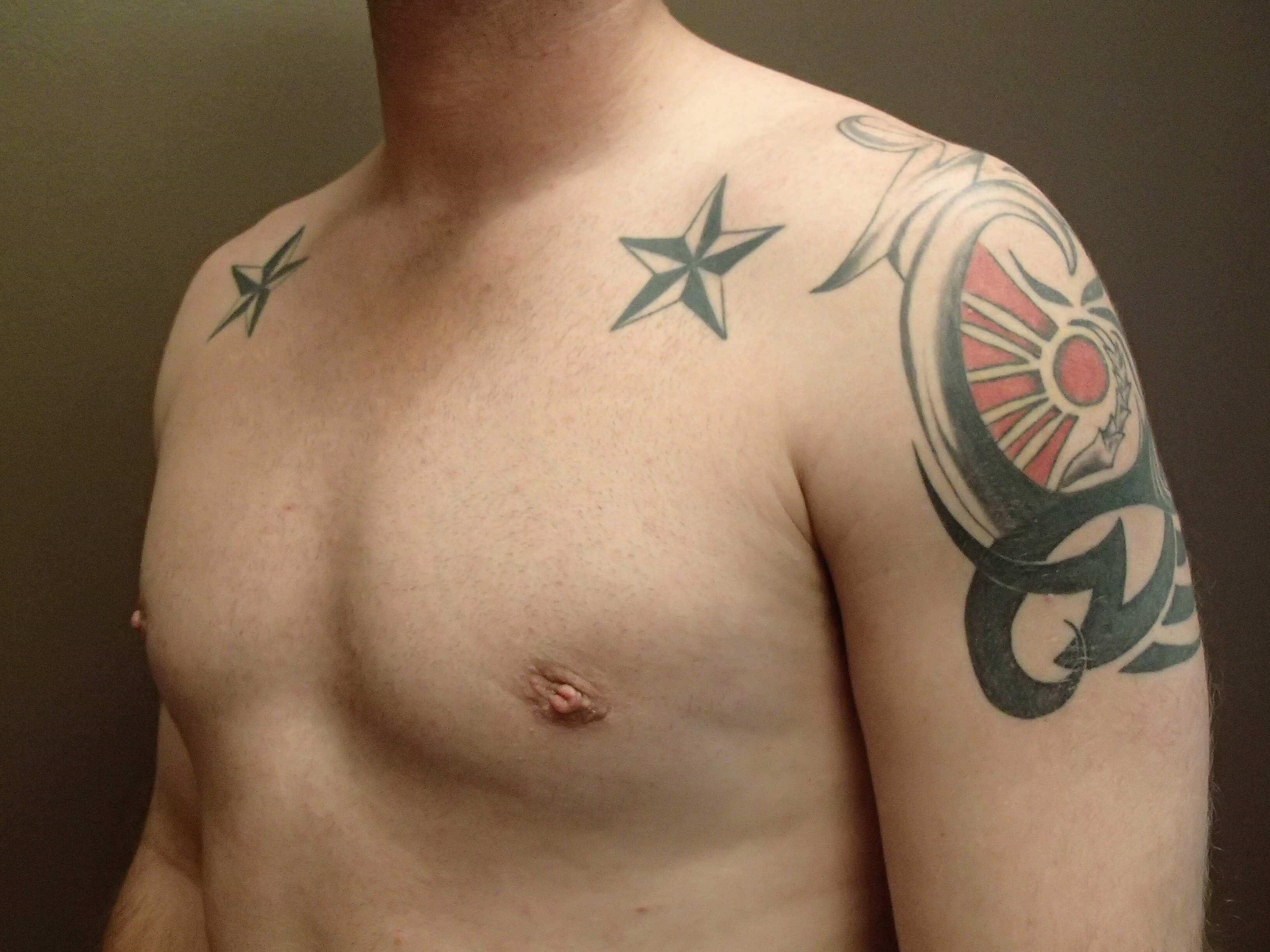 Gynecomastia (male breast redu After