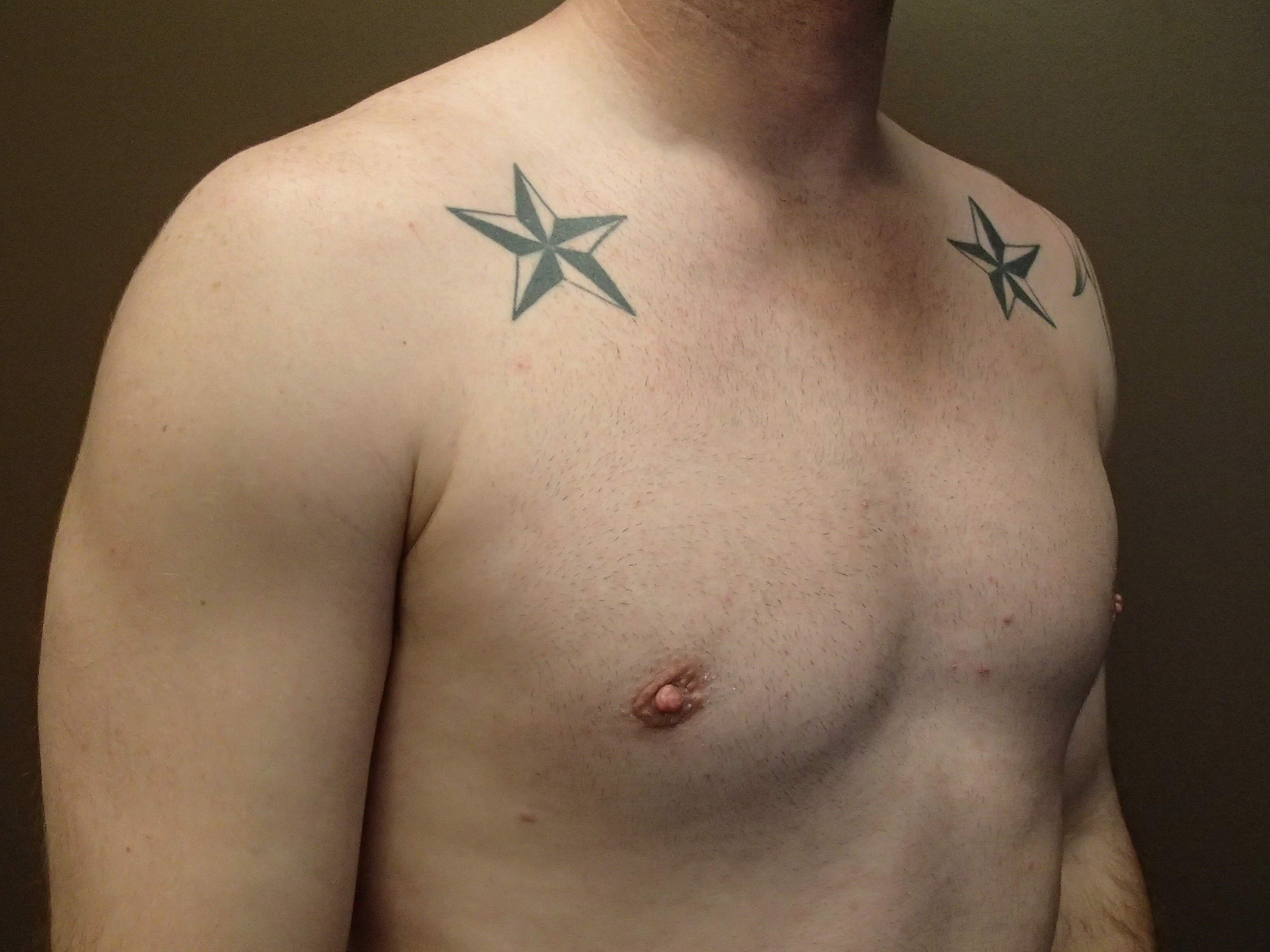 Gynecomastia (male breast redu After