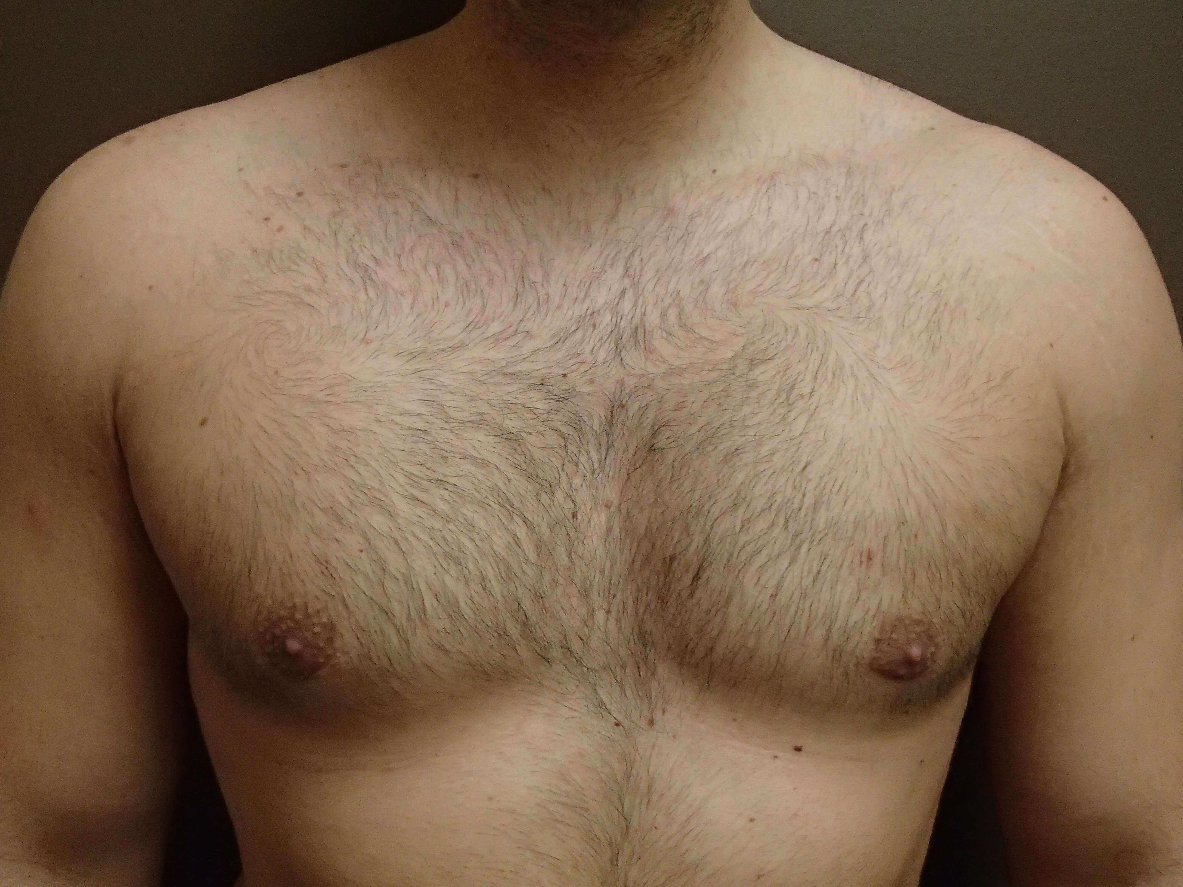 Gynecomastia (male breast redu After