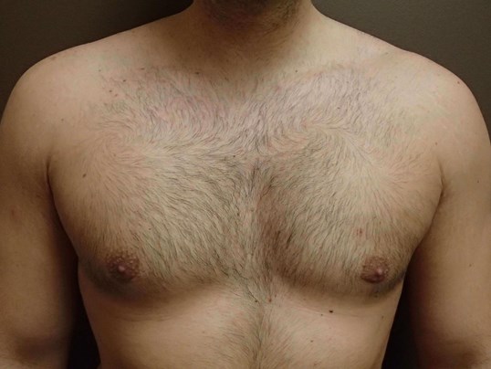 Gynecomastia (male breast redu After