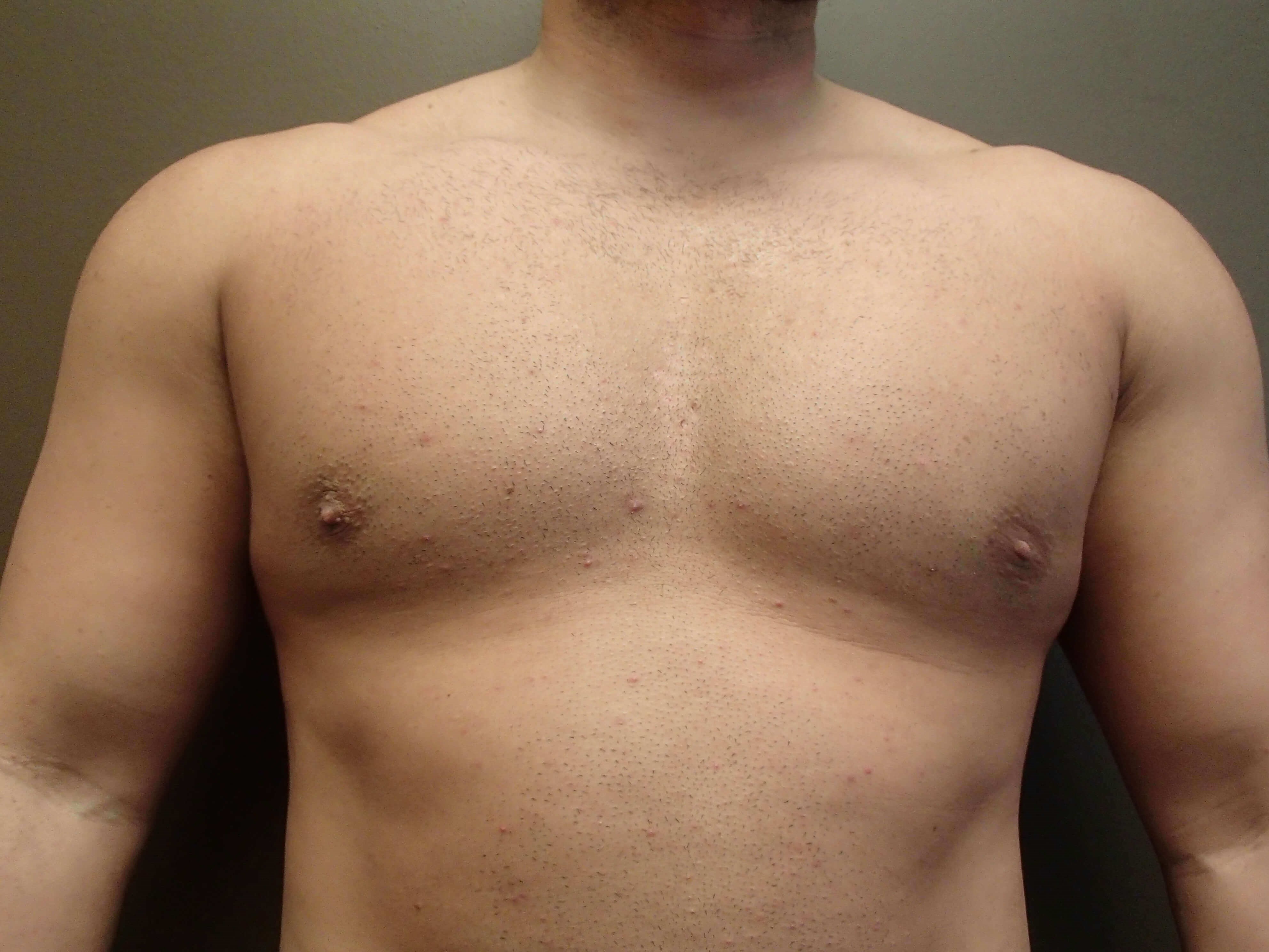 Gynecomastia (male breast redu After