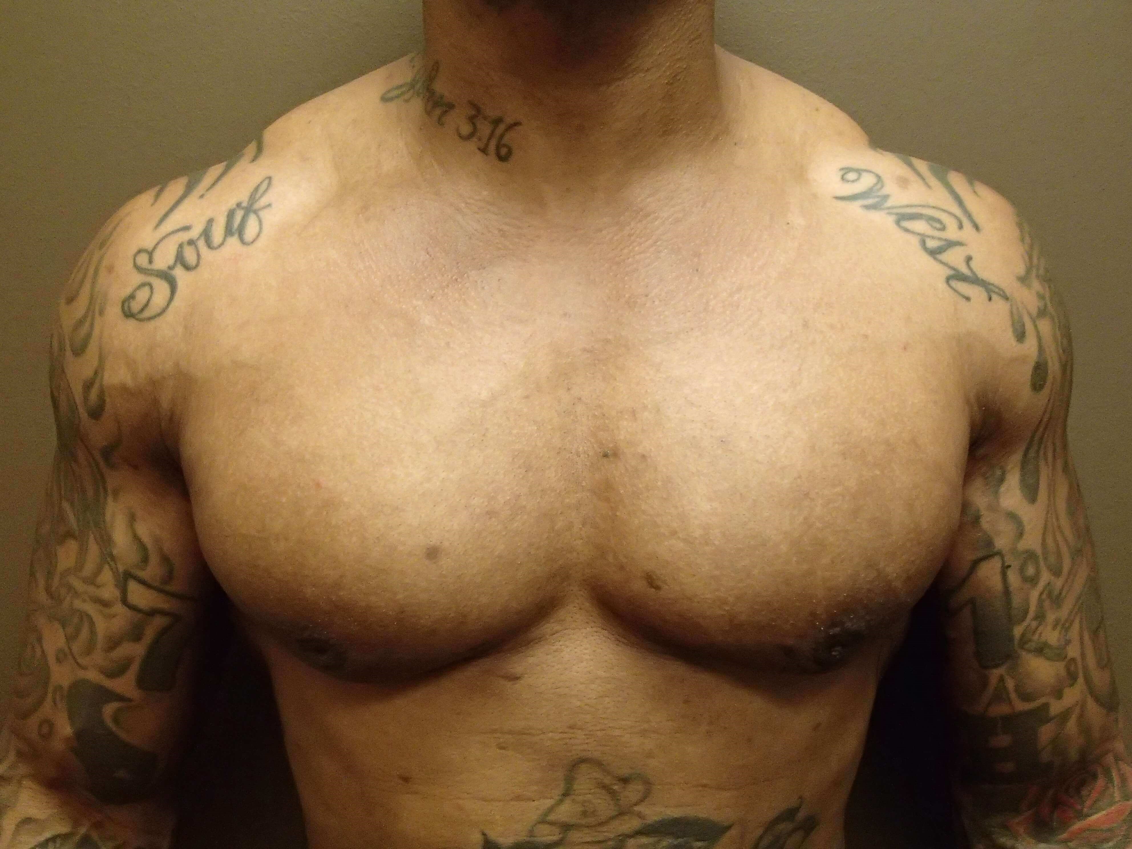 Gynecomastia (male breast redu After