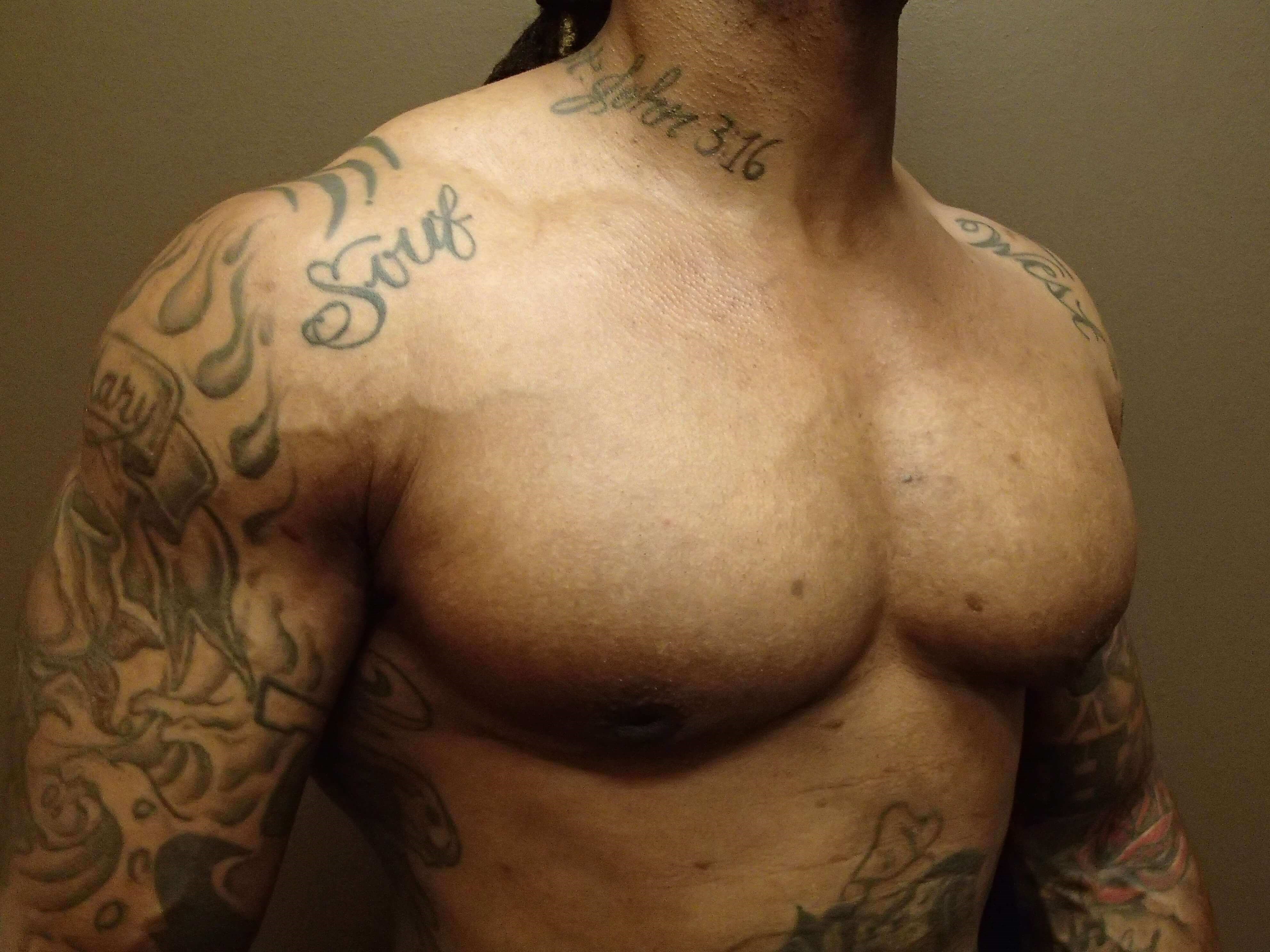 Gynecomastia (male breast redu After