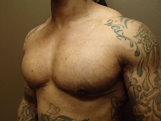 Gynecomastia (male breast redu After