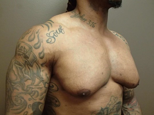 Gynecomastia (male breast redu Before