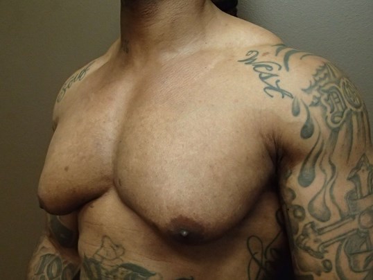 Gynecomastia (male breast redu Before
