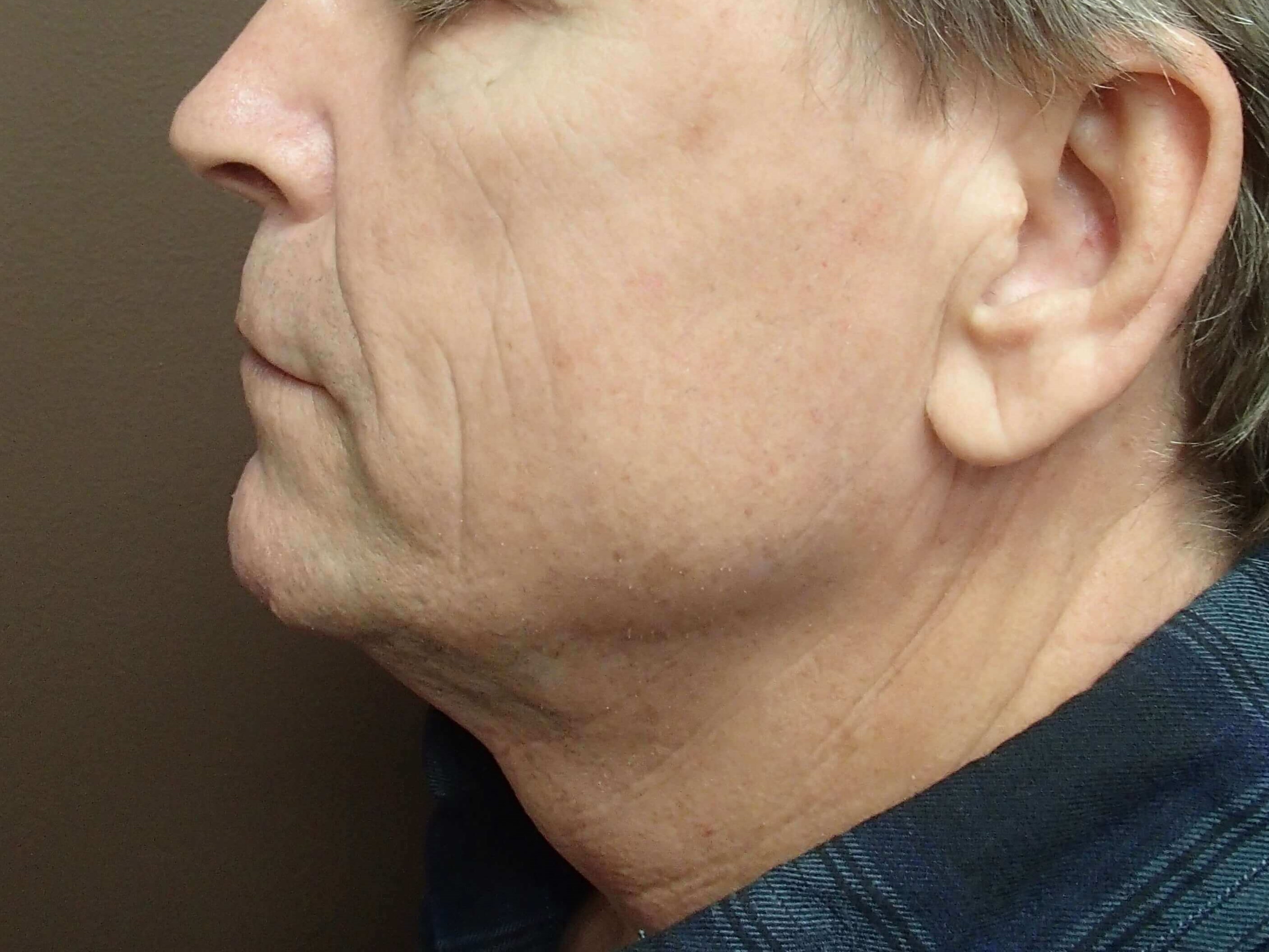 Ultherapy with Kybella After