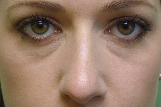 Juvederm to IOR Filler Before