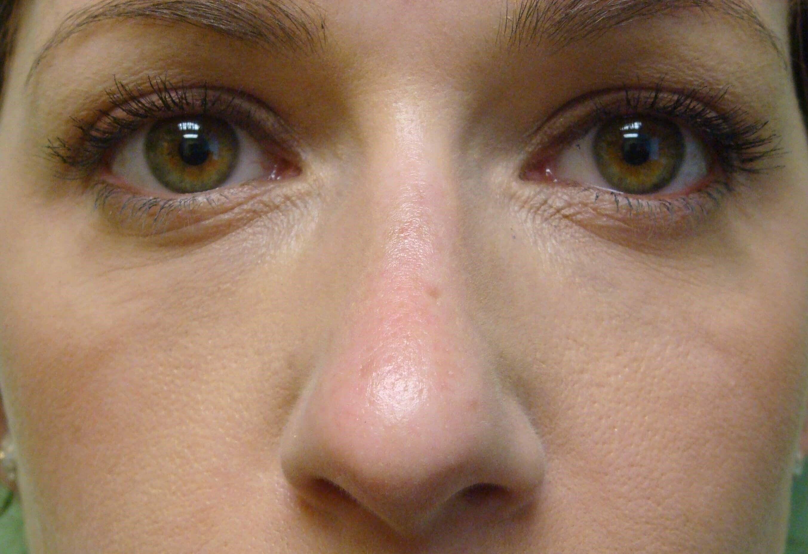 Juvederm to IOR Filler After