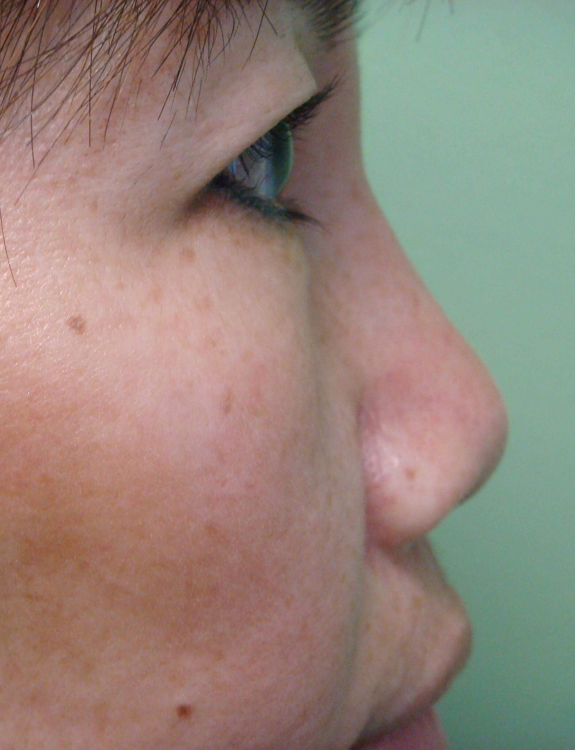 Radiesse to Nose After