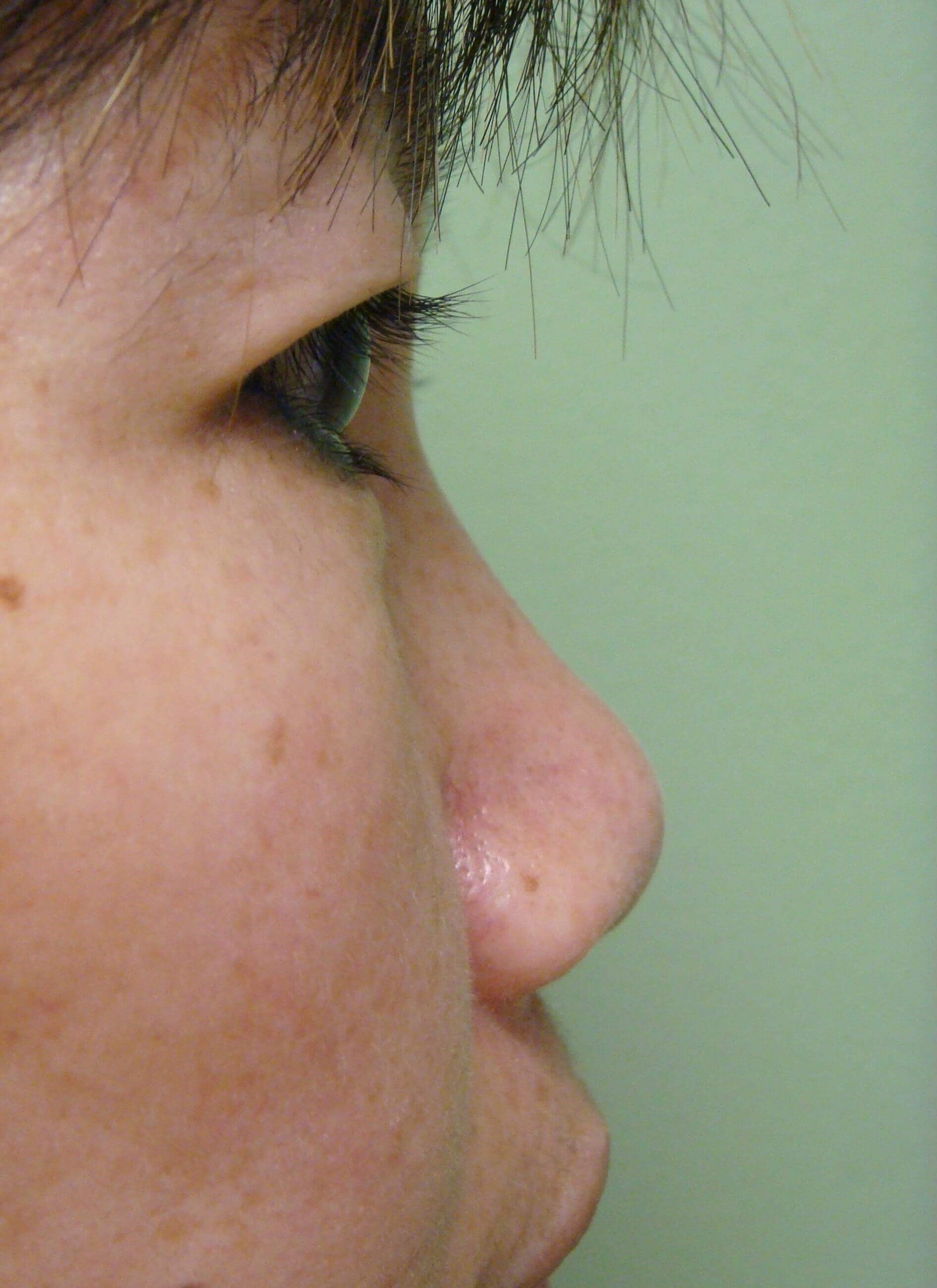 Radiesse to Nose Before
