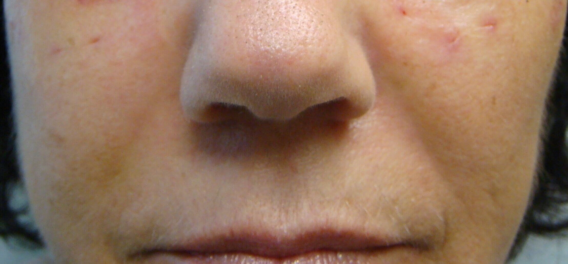 Juvederm to NLF After
