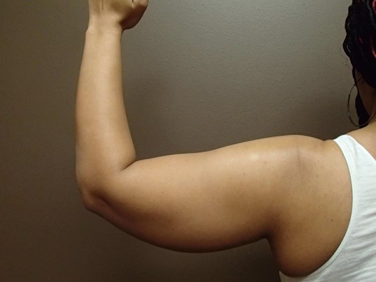 Liposuction Before