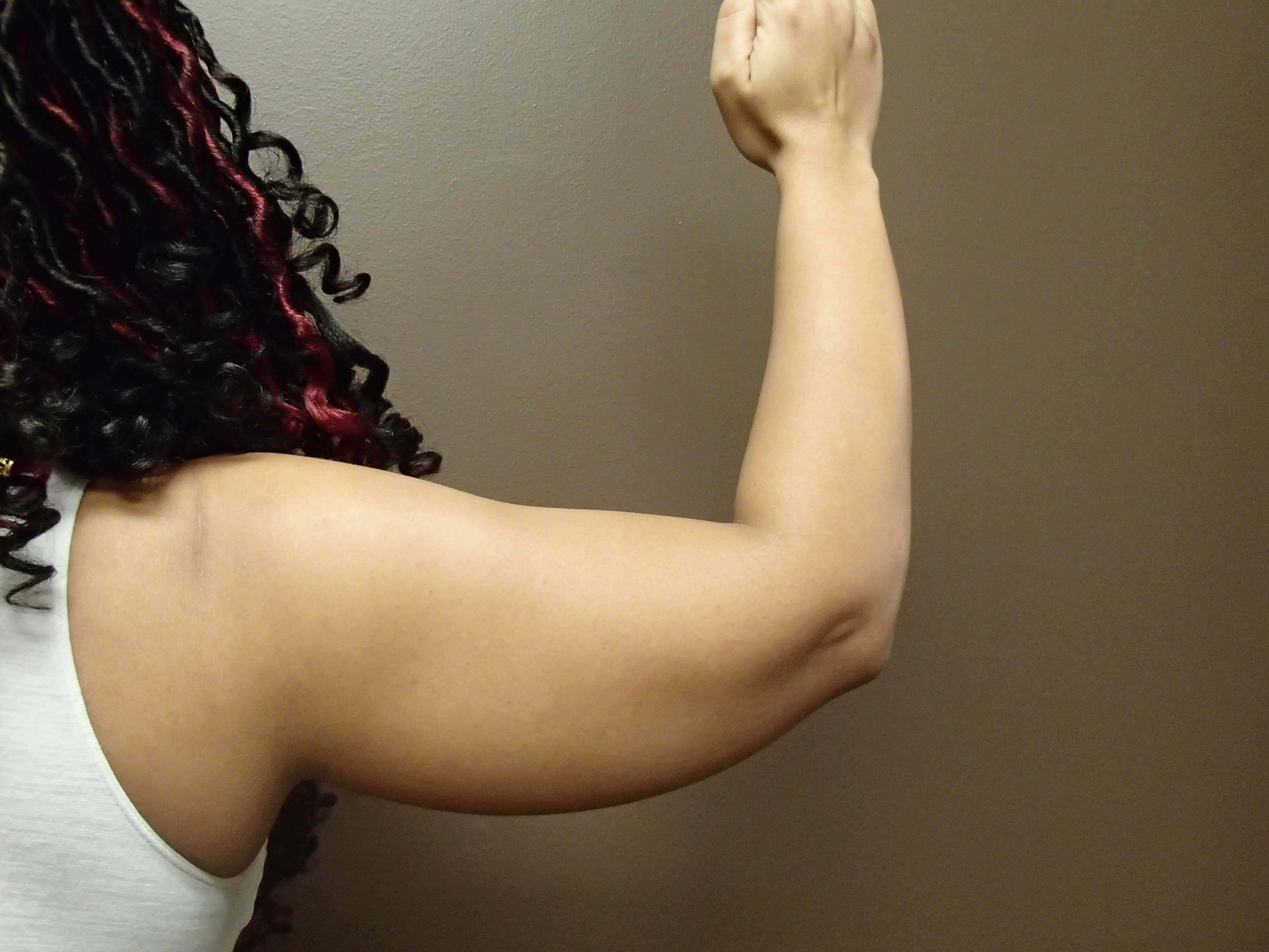 Liposuction Before