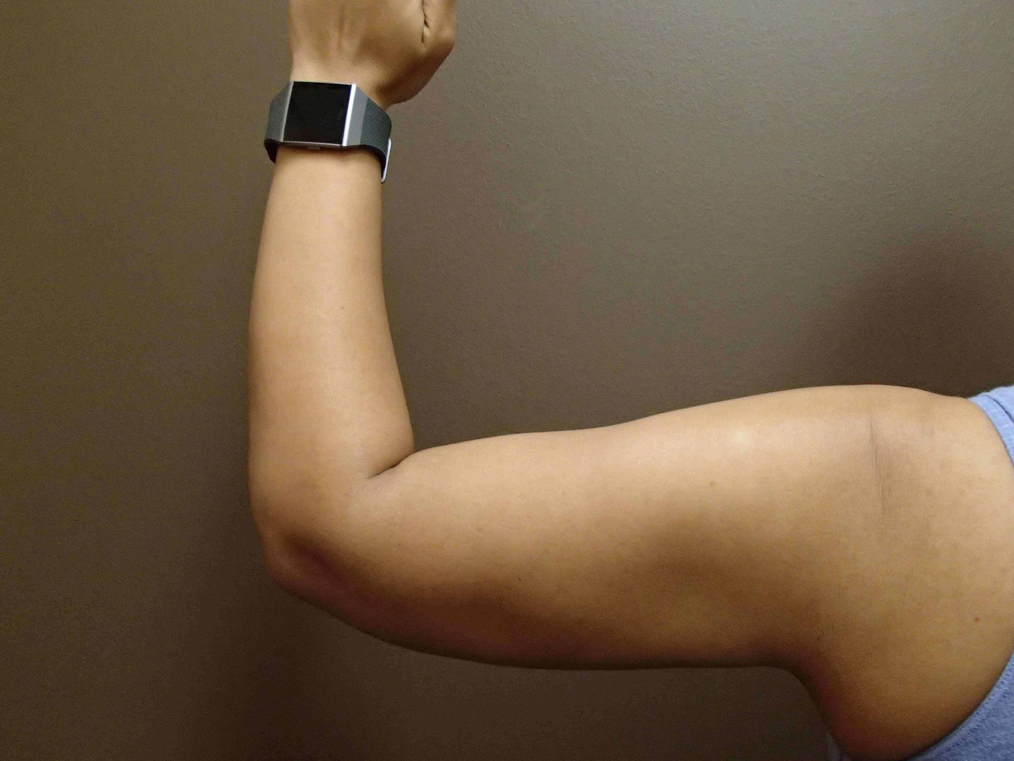 Liposuction After