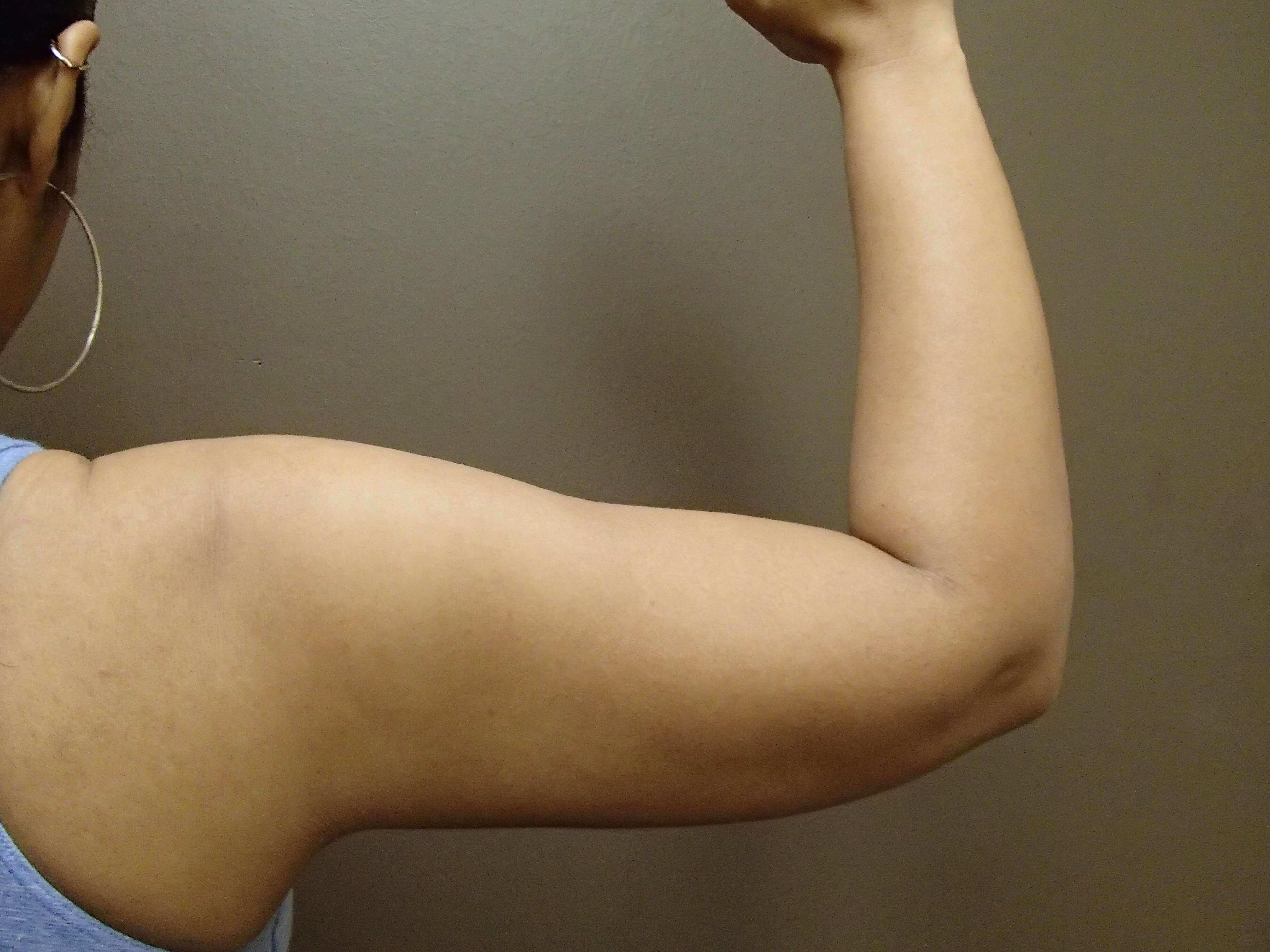 Liposuction After