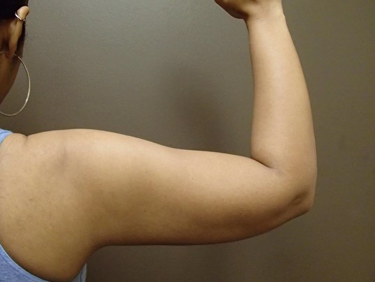 Liposuction After