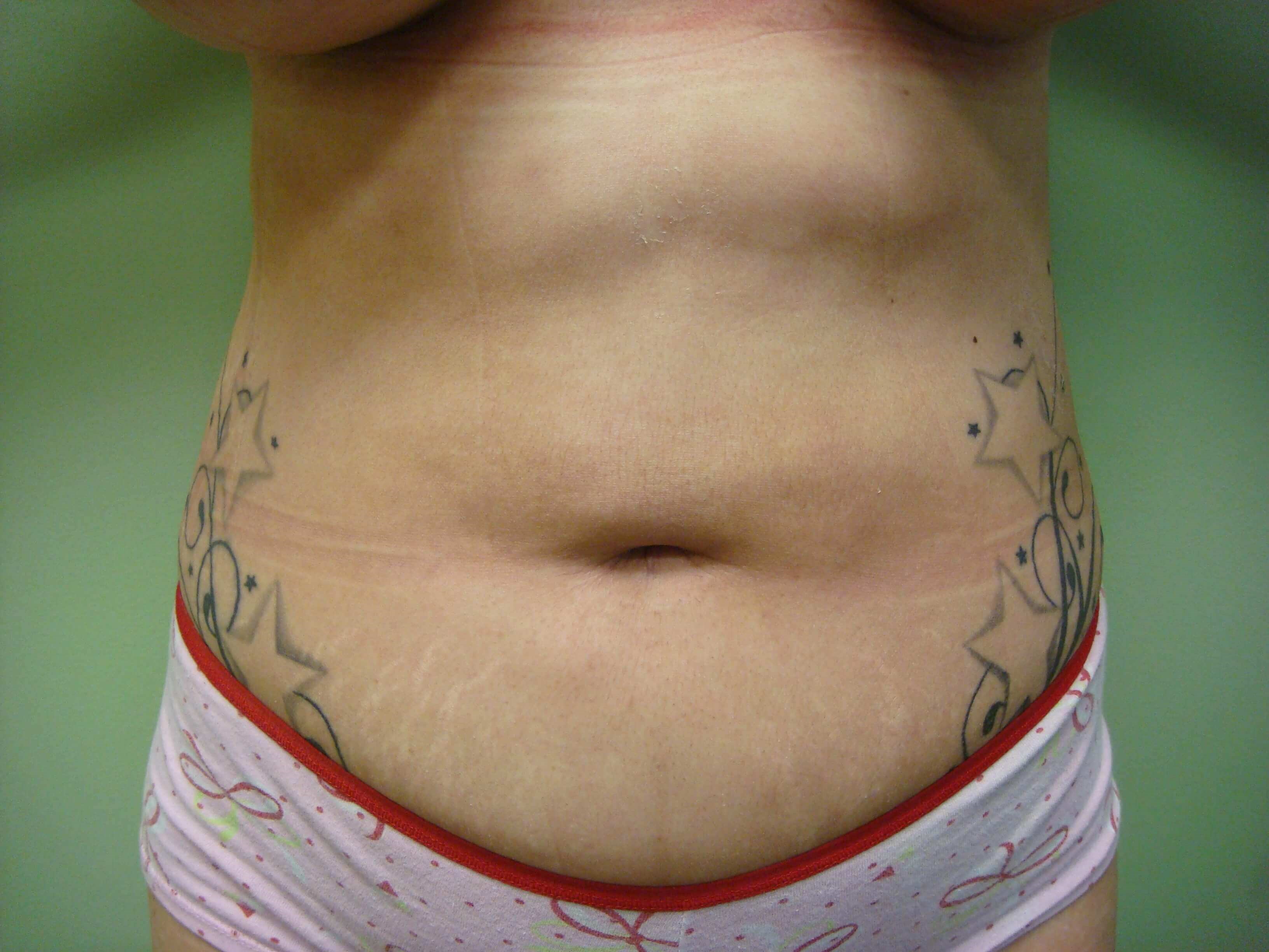 Liposuction After