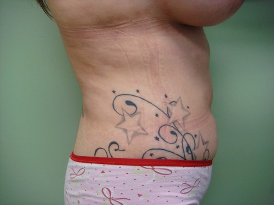Liposuction After