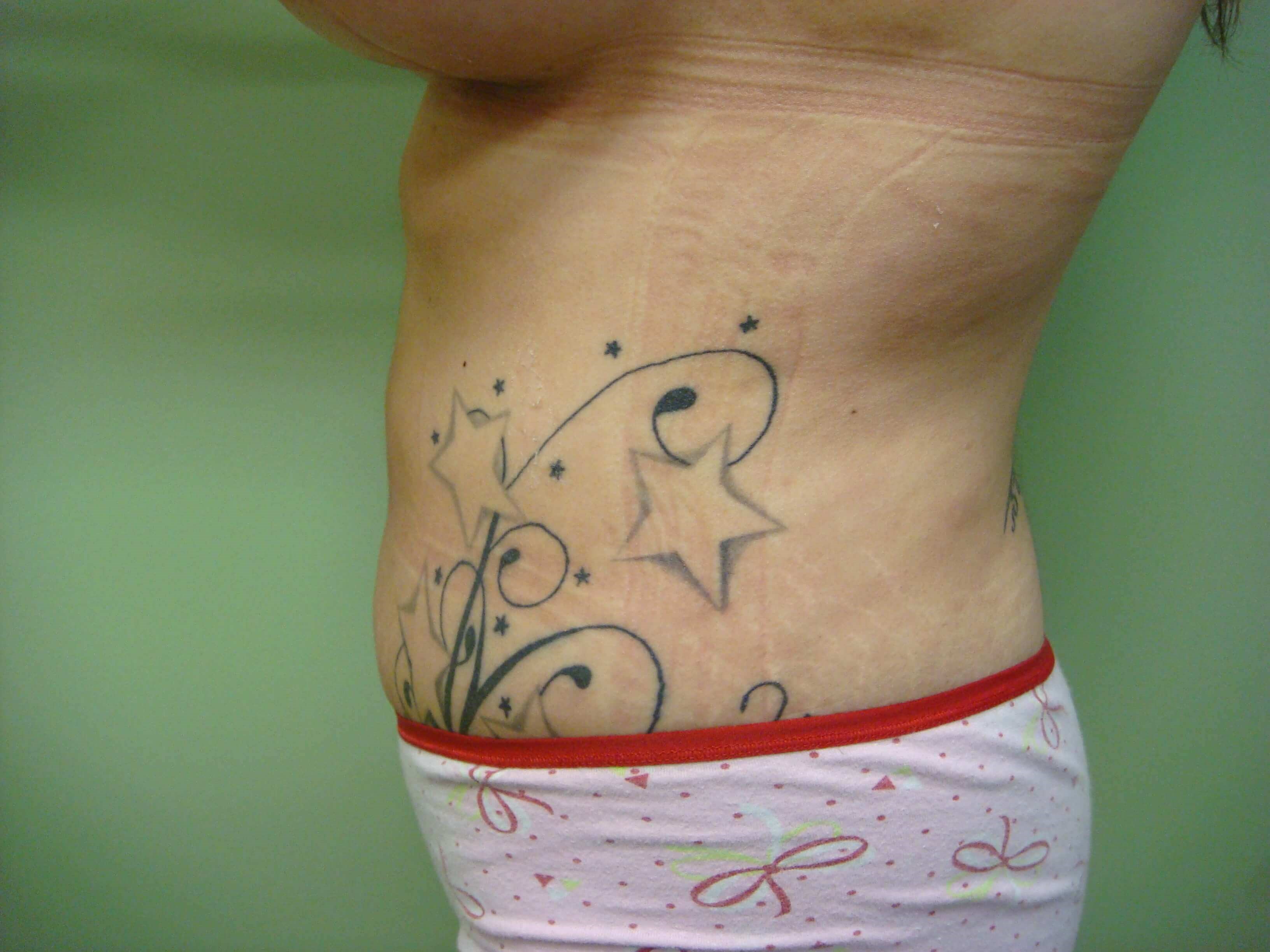 Liposuction After