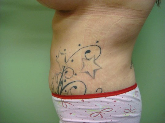 Liposuction After