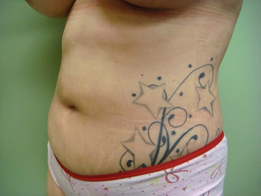 Liposuction After