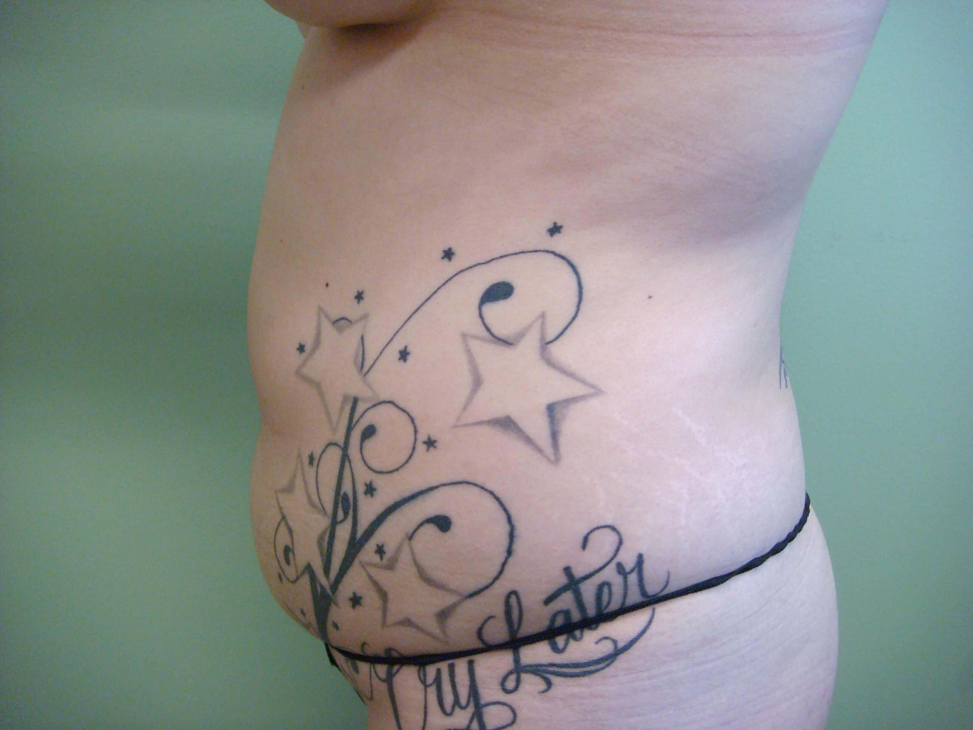 Liposuction Before