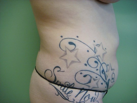 Liposuction Before