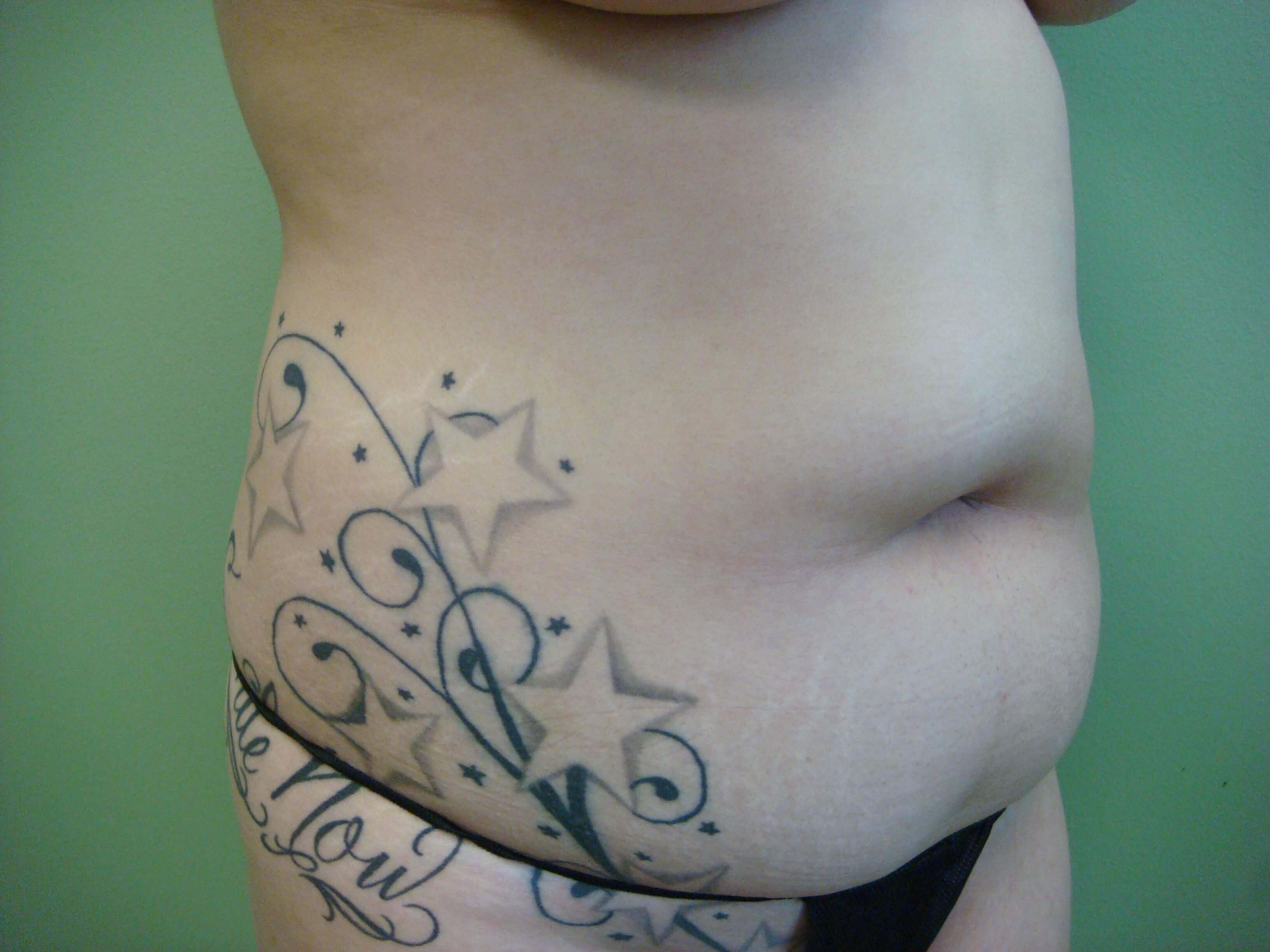 Liposuction Before