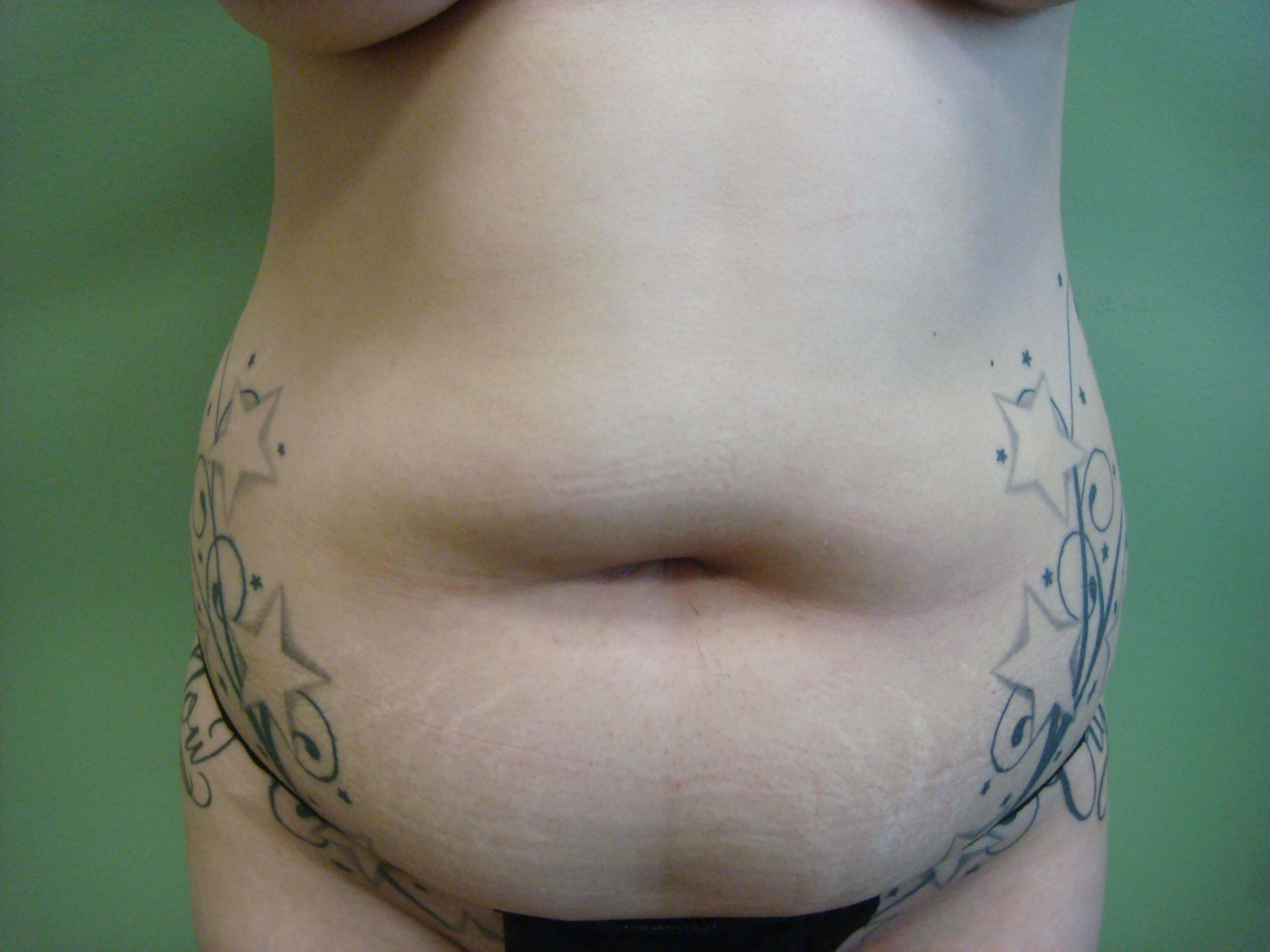 Liposuction Before