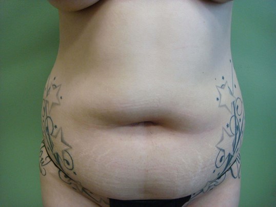 Liposuction Before