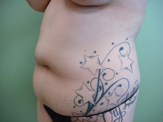 Liposuction Before