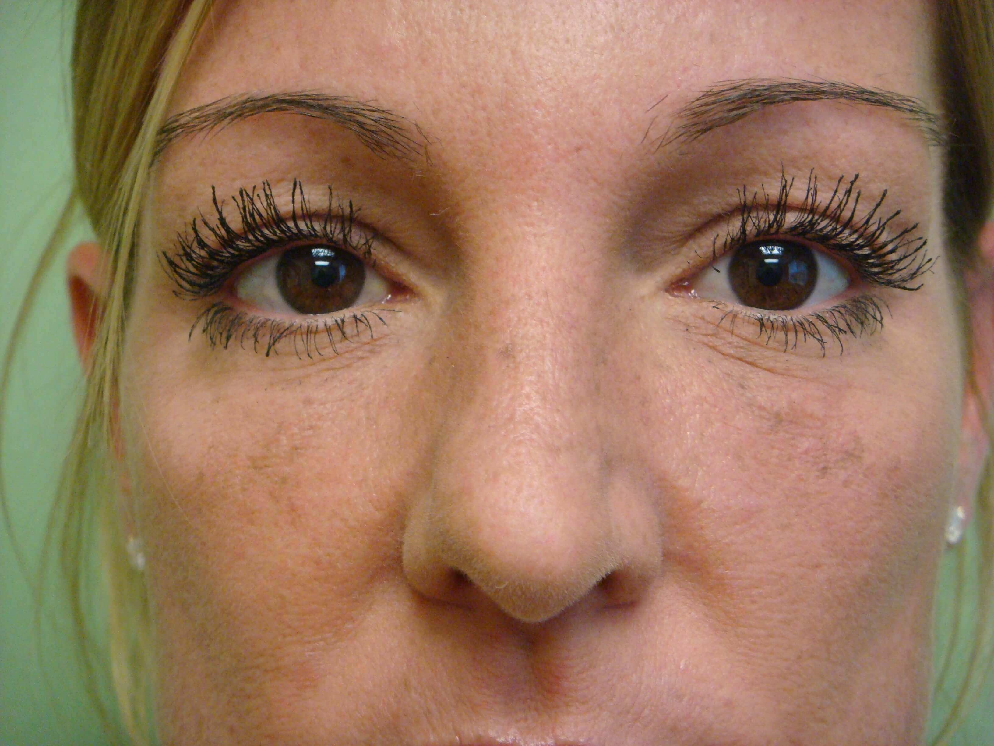 Juvederm After
