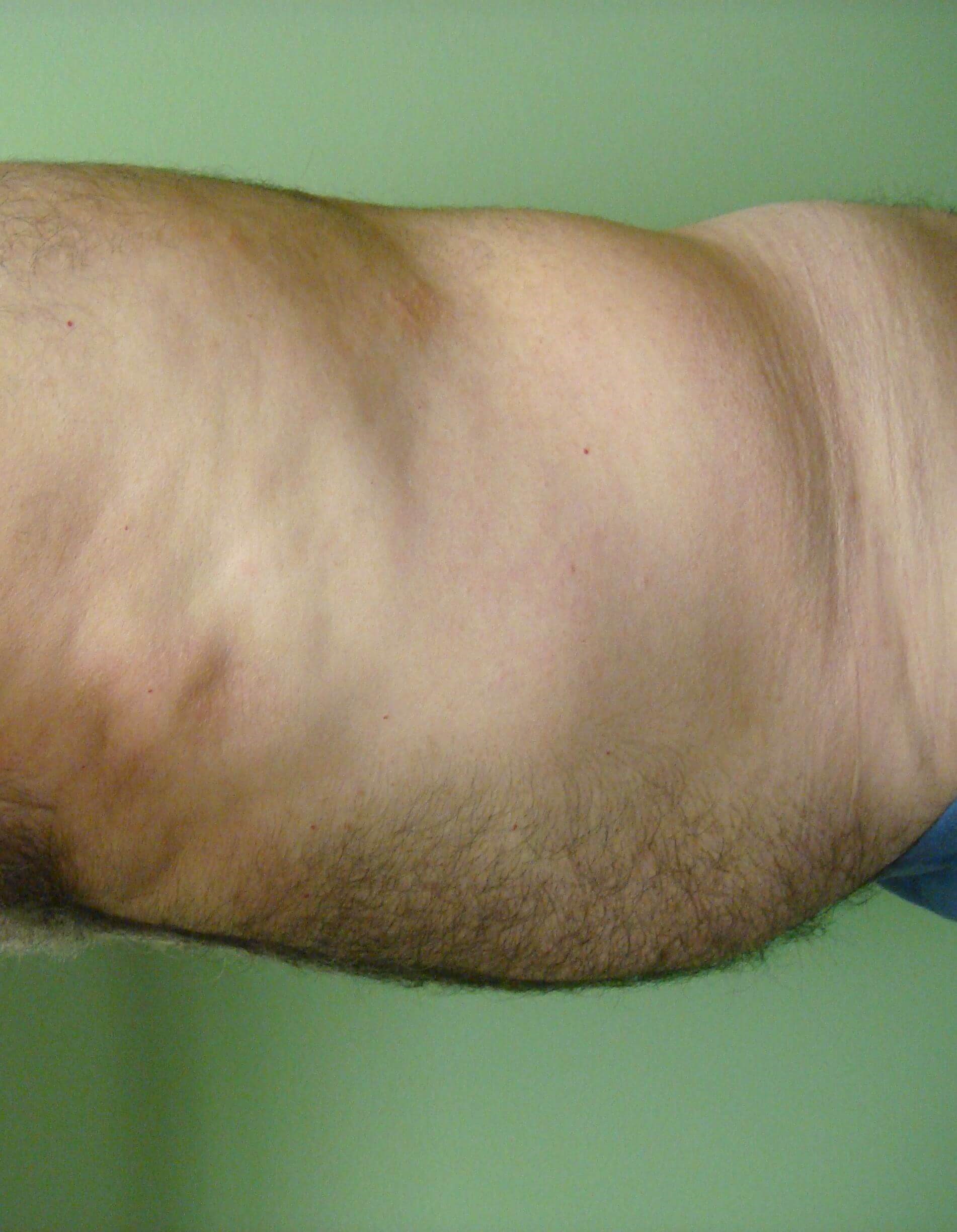 Liposuction Before
