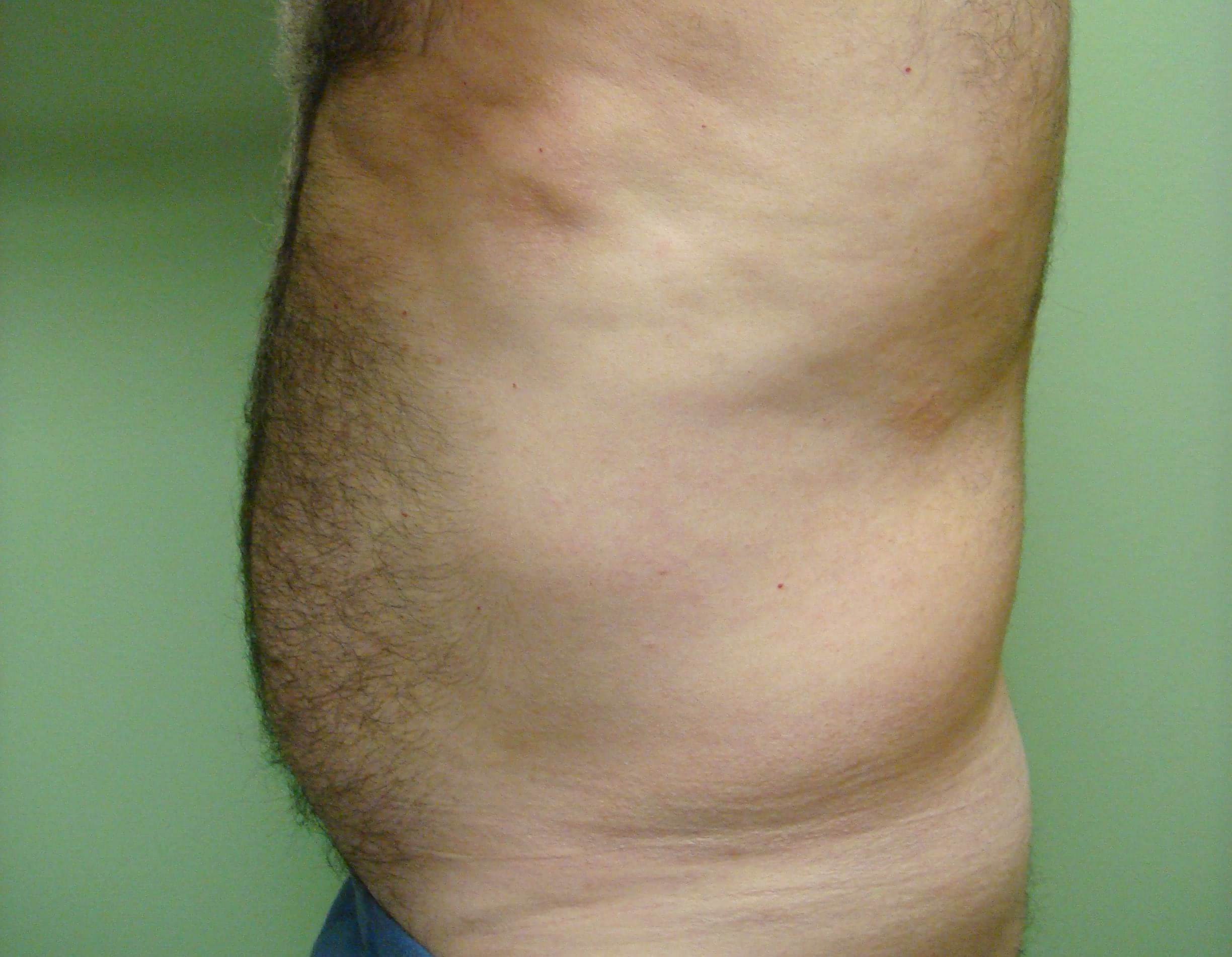 Liposuction Before