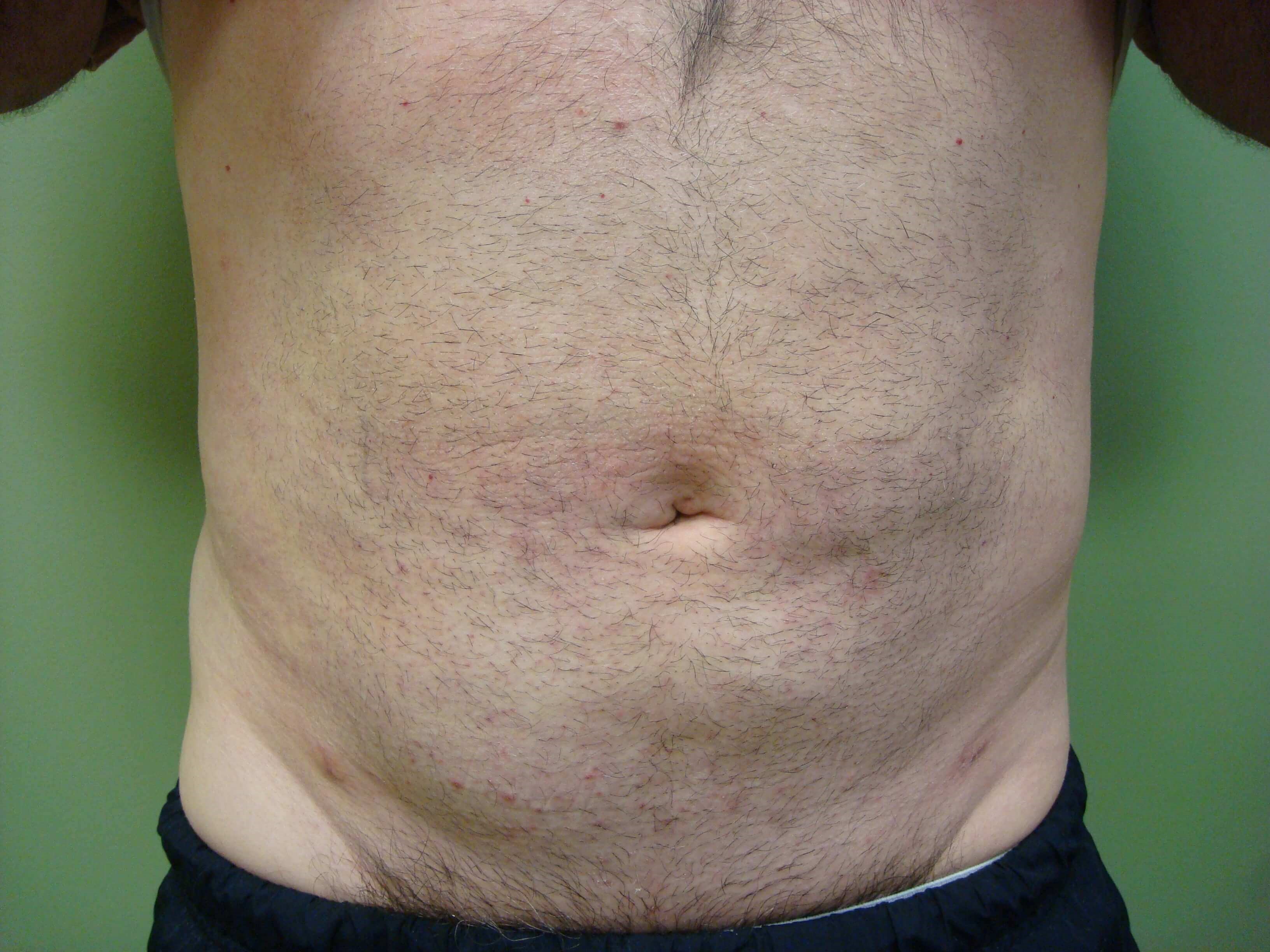 Liposuction After