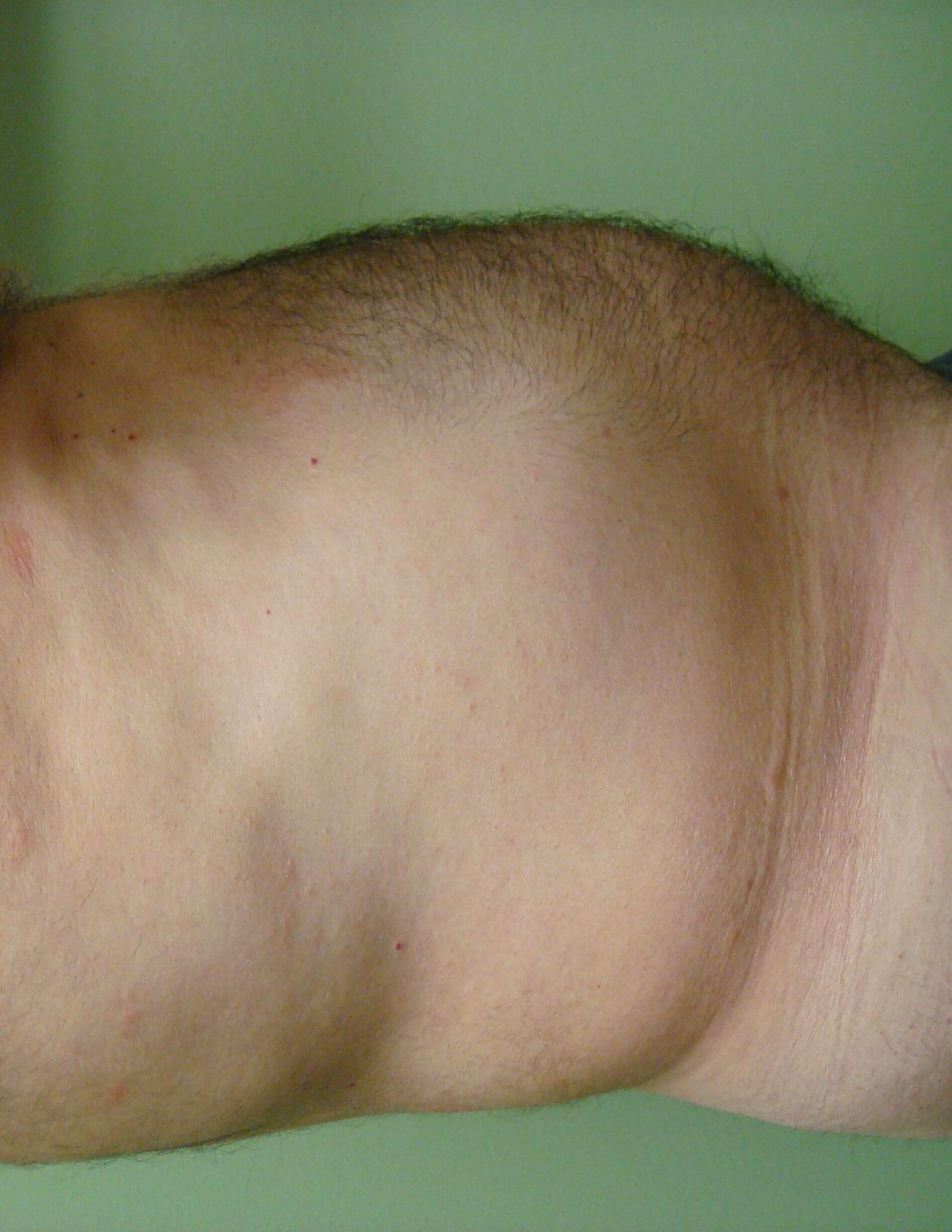 Liposuction Before