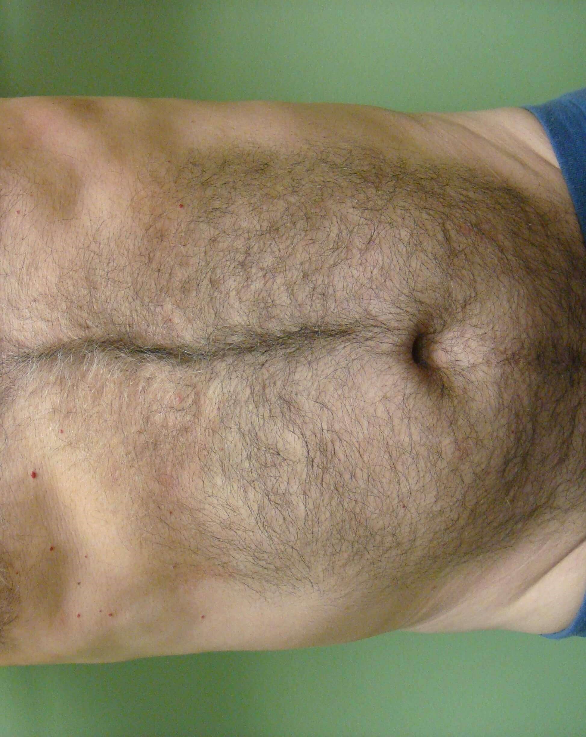 Liposuction Before