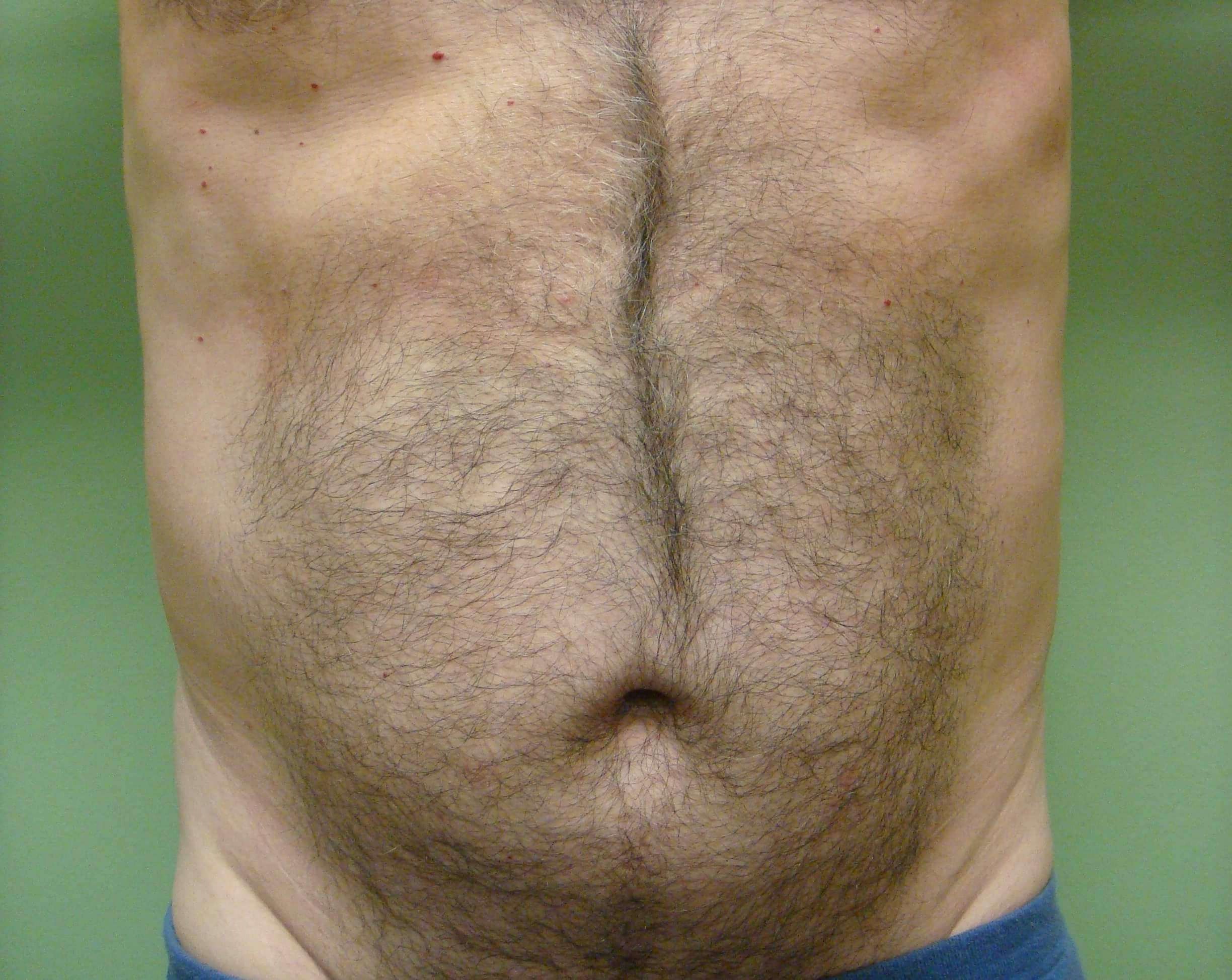 Liposuction Before