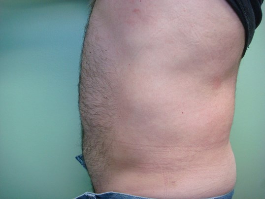Liposuction After