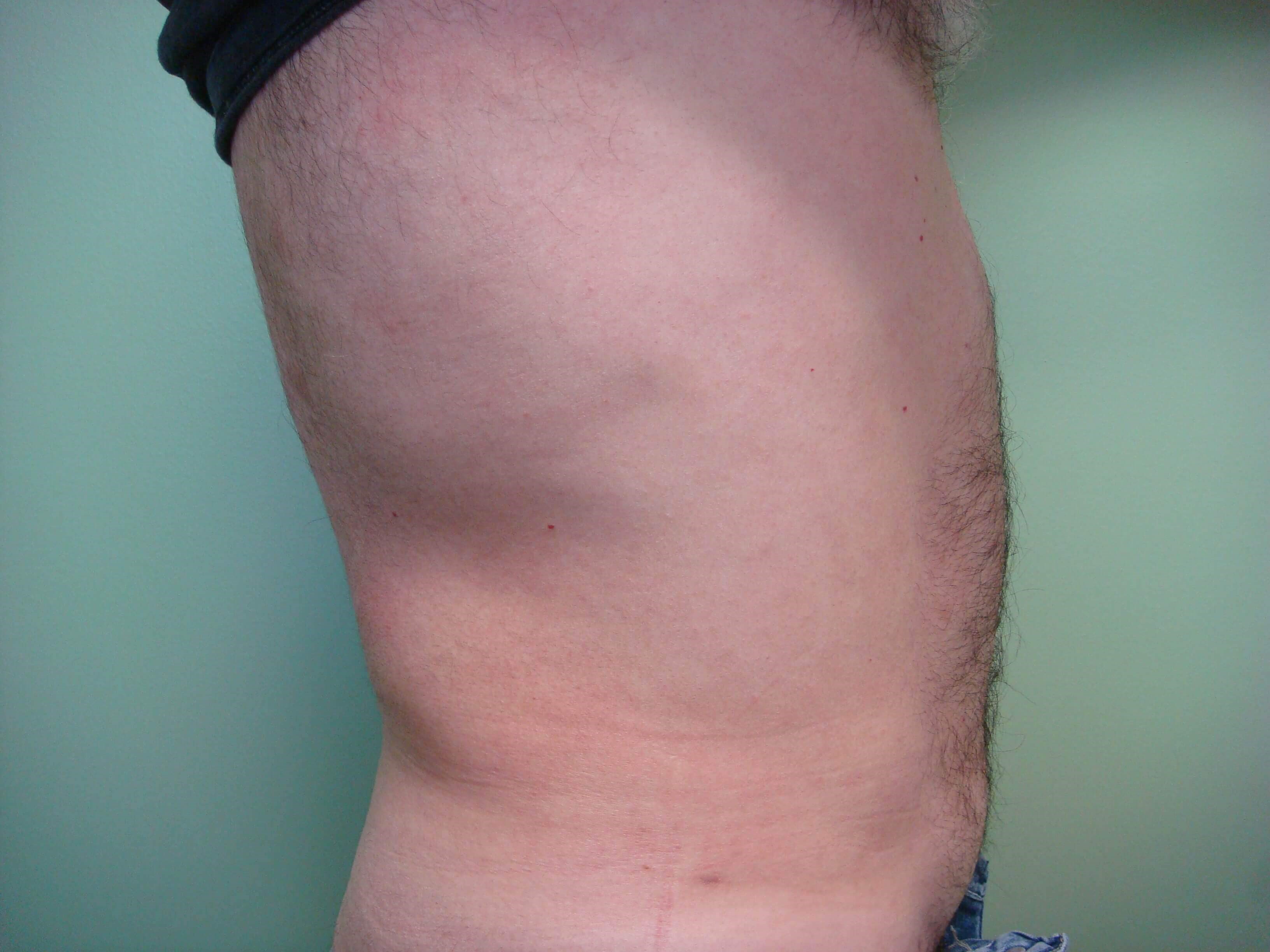 Liposuction After