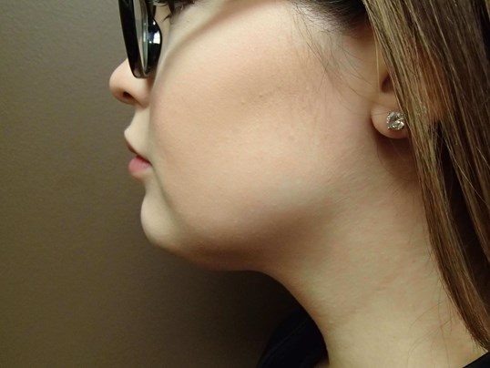 Kybella Before