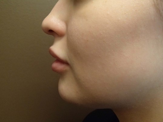 Kybella After