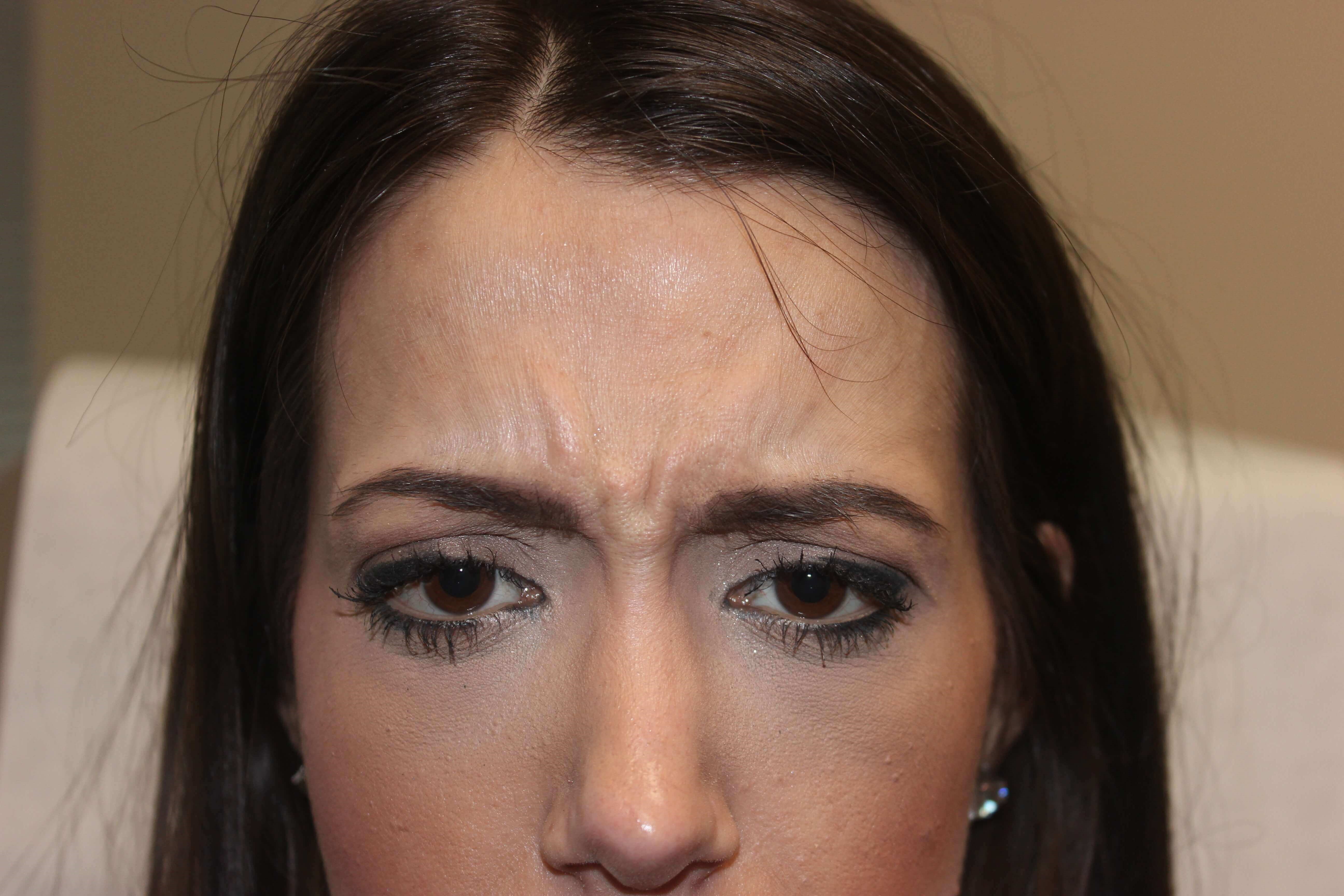 Botox Before