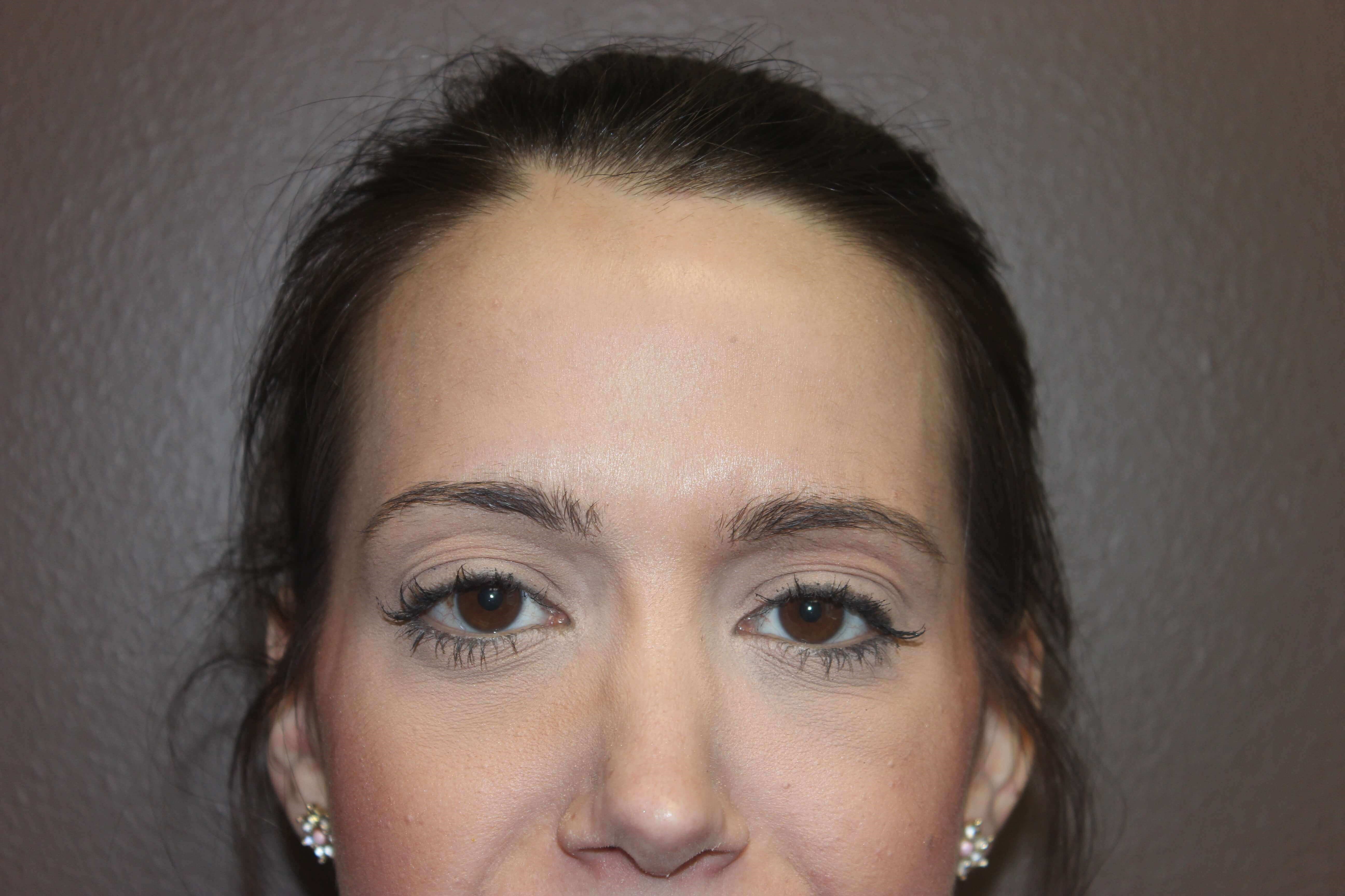 Botox After