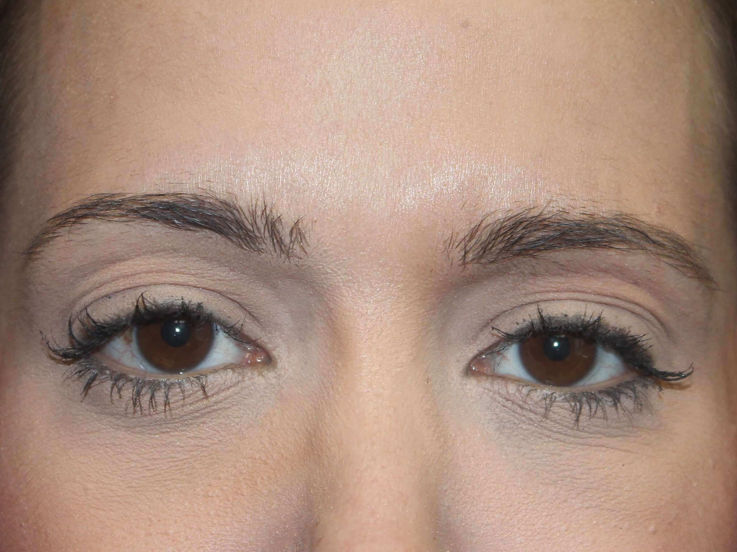 Botox After